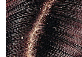 Dandruff 1 Dandruff 1