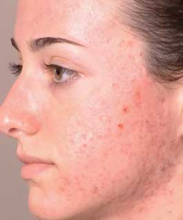 Pimples Pimples